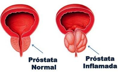 Enuresis és prostatitis invasive prostatic adenocarcinoma acinar type