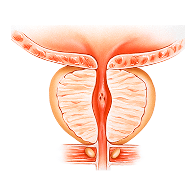Unidad de próstata